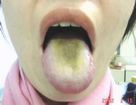 口干口苦口臭怎么回事?怎么治疗?中医辩证论治效果可靠安全