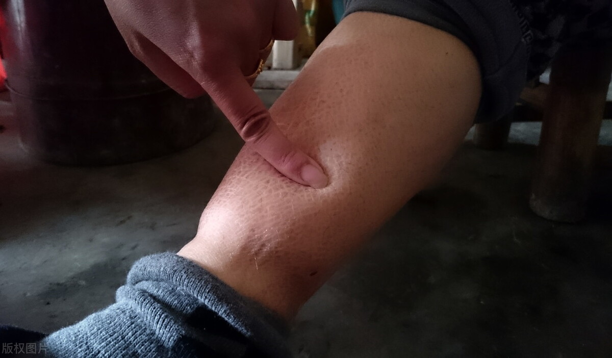 5个信号暴露身体湿气重,祛湿养好"脾胃"最重要,记好4个绝招