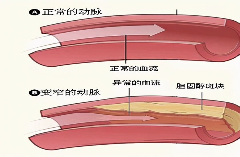 胆固醇正不正常?化验单说得还不算,什么原因?医生为您讲清楚
