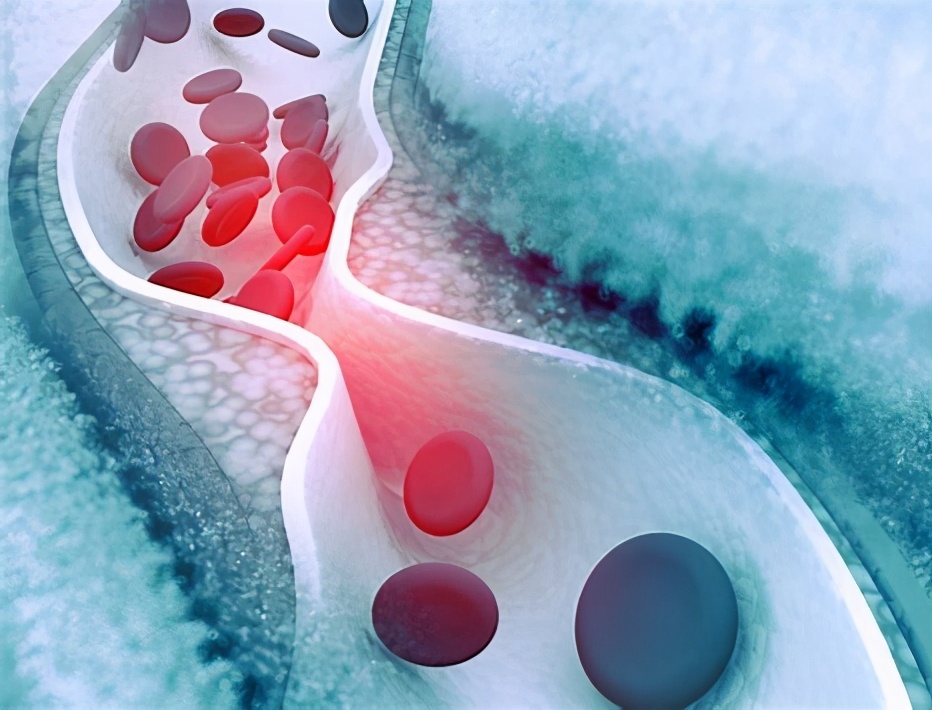 胆固醇正不正常?化验单说得还不算,什么原因?医生为您讲清楚