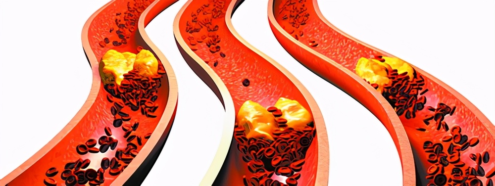 血管真的需要及时排毒清垃圾?别被忽悠了!这四个认识误区请收好