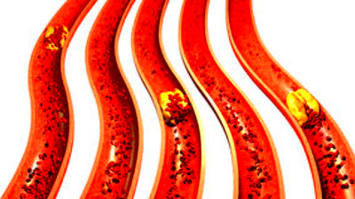 吃了阿司匹林,就不会再犯心脏病和脑梗了吗?医生为您讲清楚