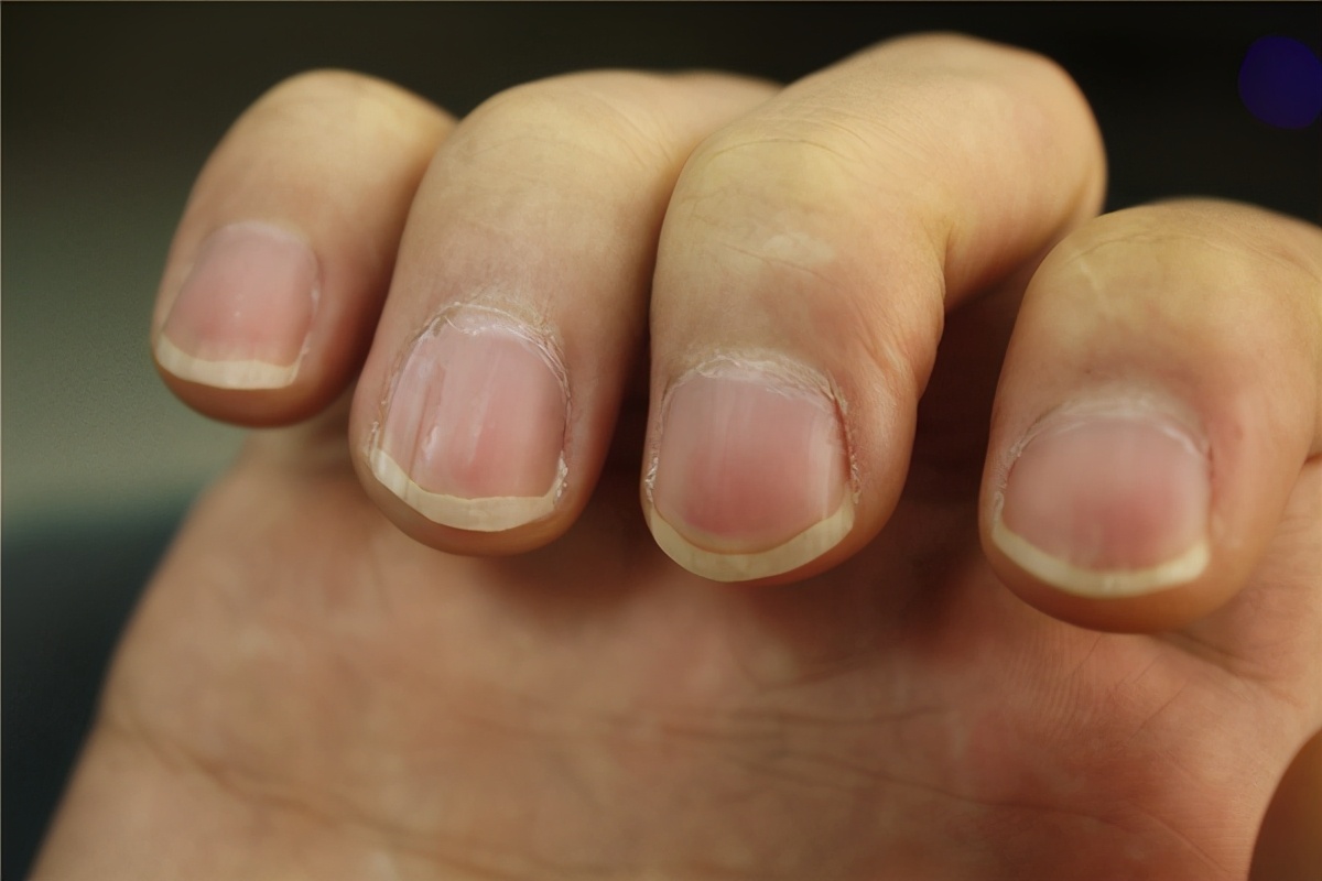 指甲上出现竖纹,是咋回事?月牙的多少,与健康有关?