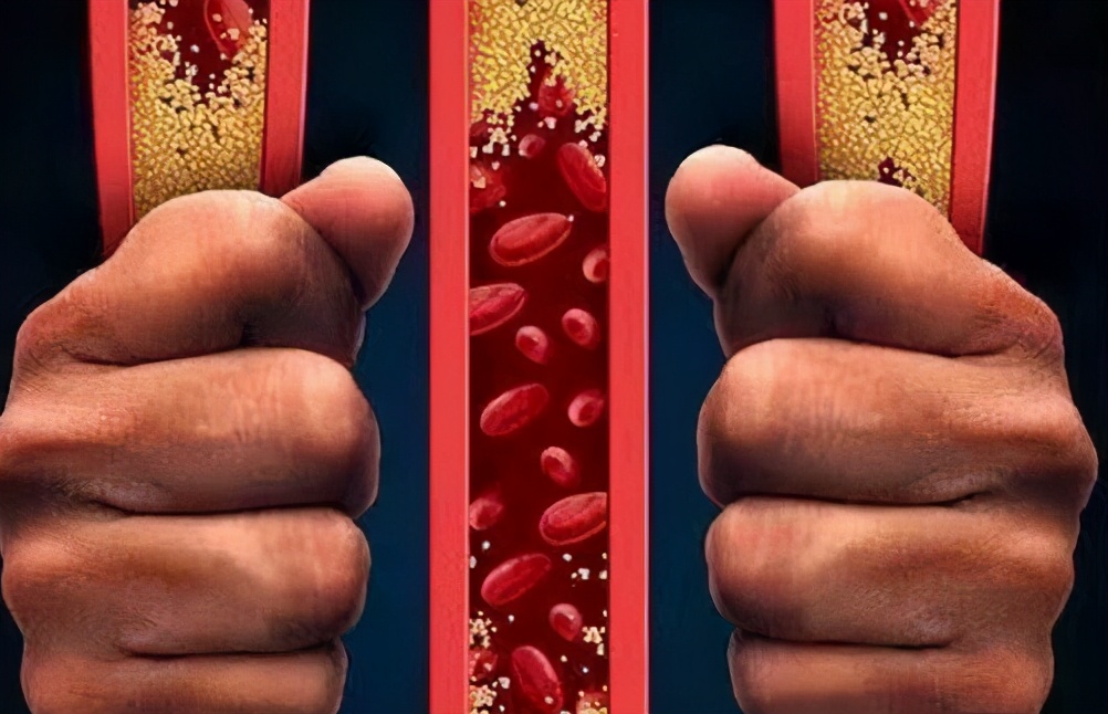 102岁老人,血管年龄60岁,血管年轻阻断高血脂,是3习惯
