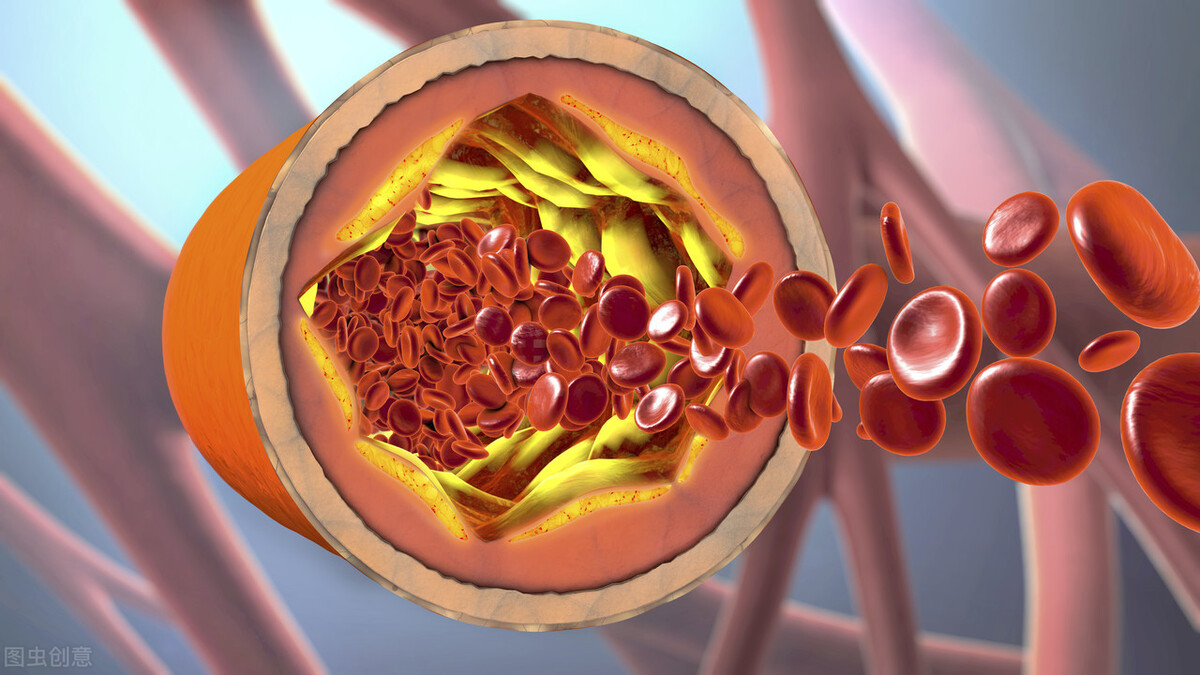 患有静脉曲张怎么办?记住这几点会对你有好处