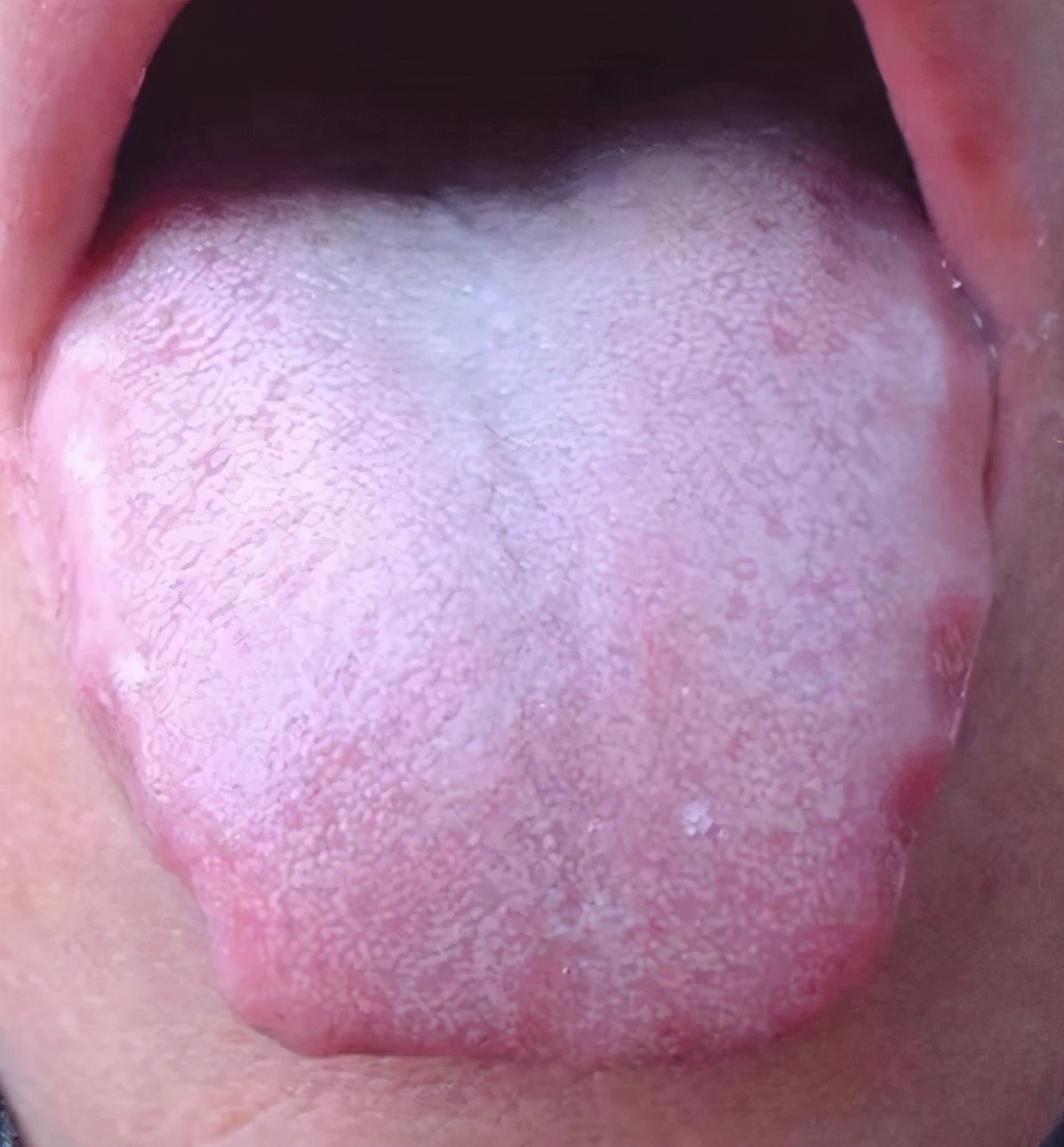 爱吃肉,当心脾胃不好!3种常见脾胃病,中医教你如何调理