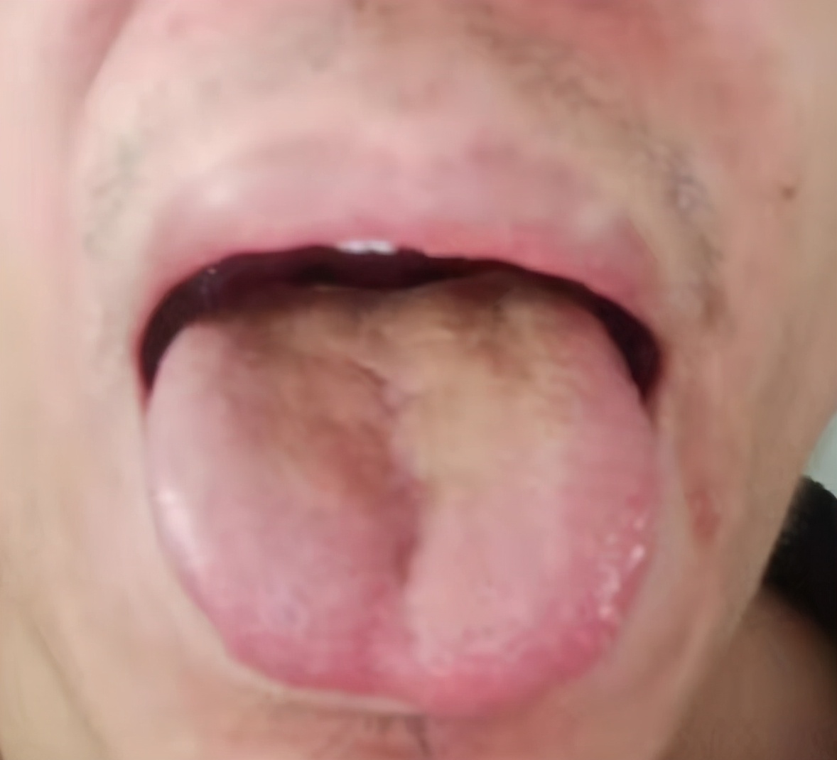 爱吃肉,当心脾胃不好!3种常见脾胃病,中医教你如何调理