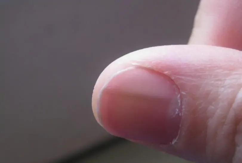 指甲上出现“竖纹”,或是这5个原因导致的,别总是瞎想