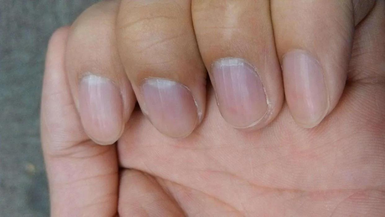 指甲上出现“竖纹”,或是这5个原因导致的,别总是瞎想