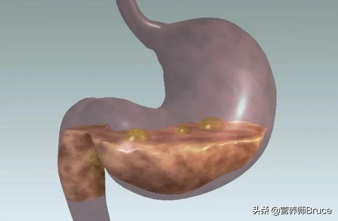 胃胀、胃反酸、胃溃疡,可以吃什么食物缓解胃酸过多?