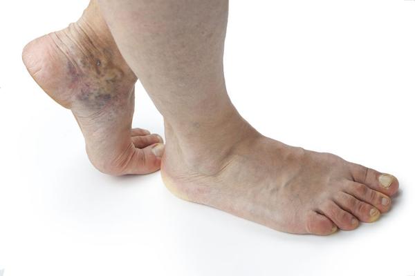 血栓缠身,腿脚先知?若有这4个迹象,或暗示血管已堵塞