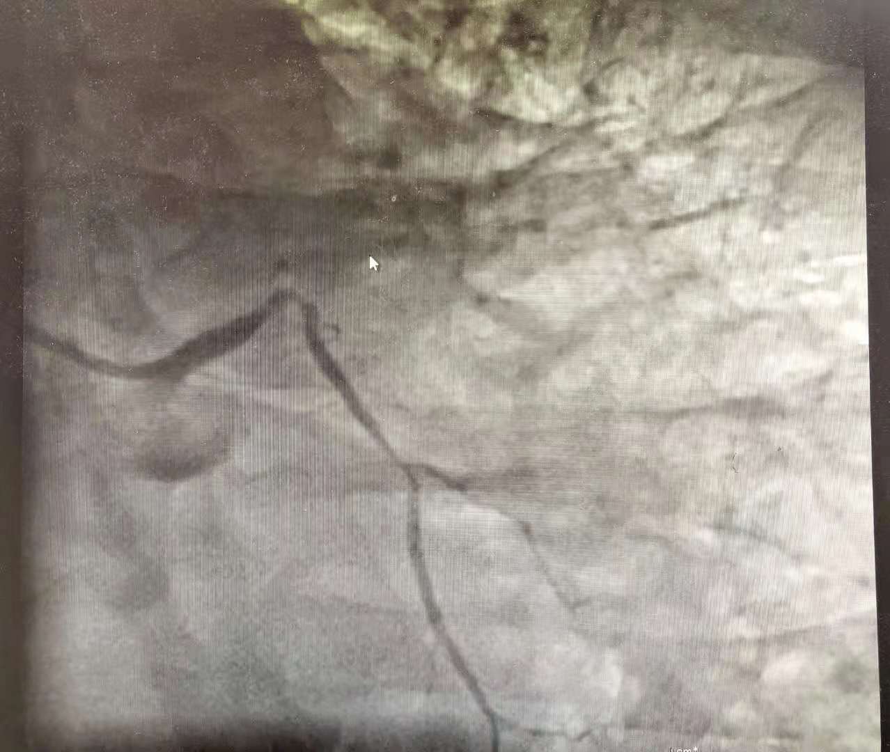 胃病疼了2年,却突发心梗住进抢救室,一天花4万!医生:误诊了