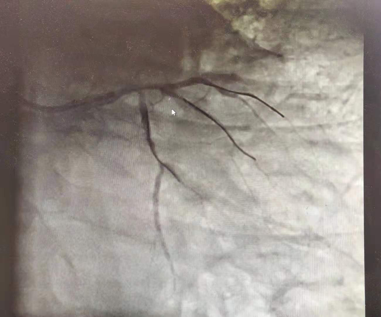 胃病疼了2年,却突发心梗住进抢救室,一天花4万!医生:误诊了