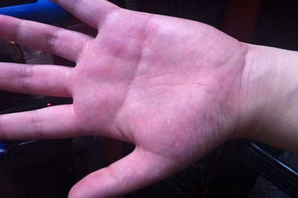 血管堵不堵?看看手就知道?手上若有3种“异常”,或血管易堵塞